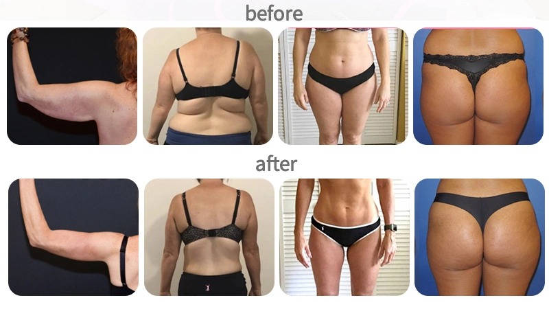 Bodytech Beauty Salon Equipment Consumption Calorie EMS Session Jacket Promotes Metabolism Wonder EMS Beauty Slimming Suit